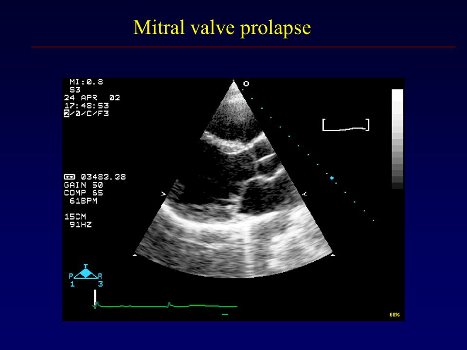 Пролапс митрального клапана презентация