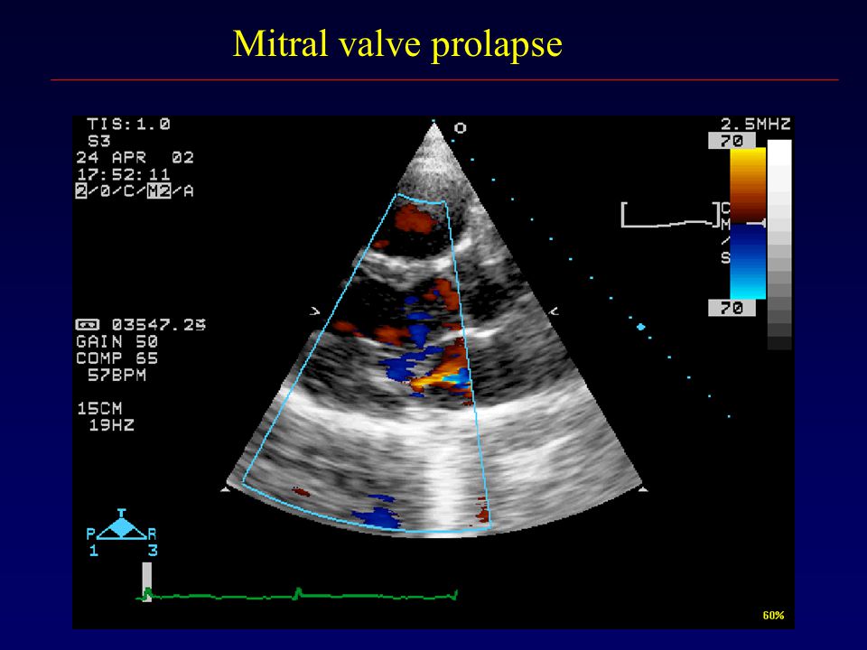Пролапс митрального клапана картинка