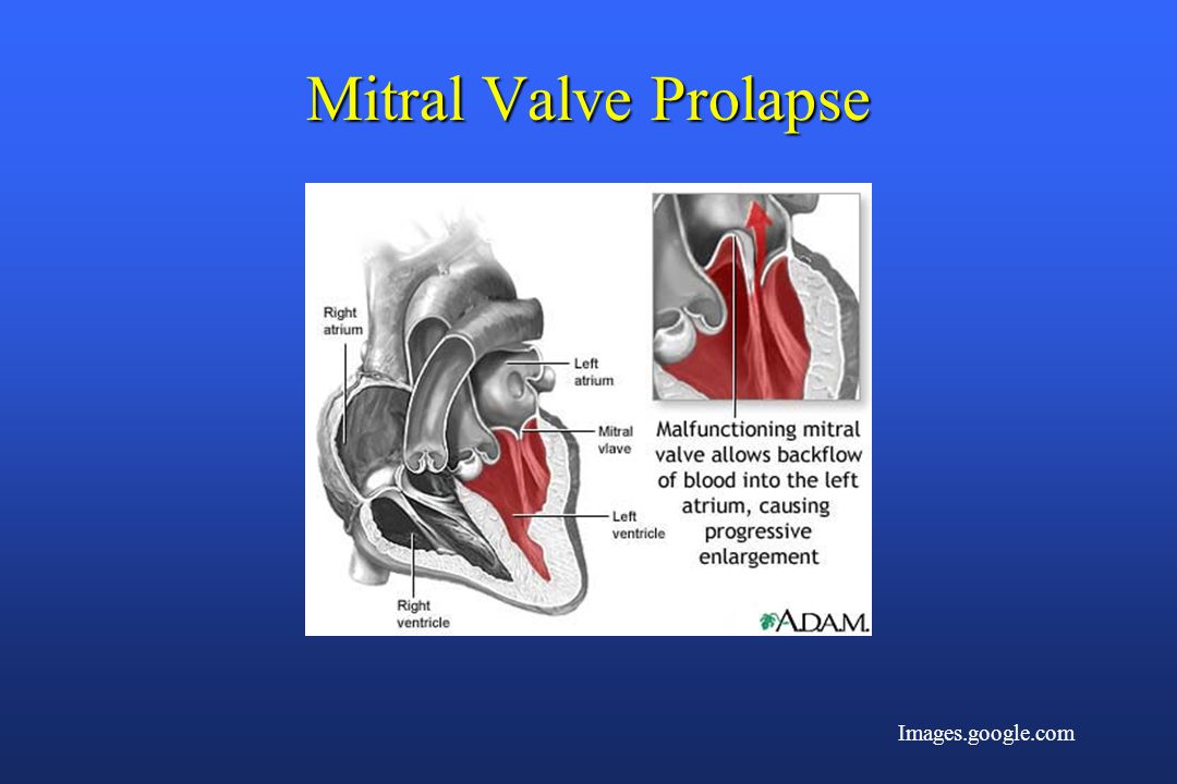 Пролапс митрального клапана презентация