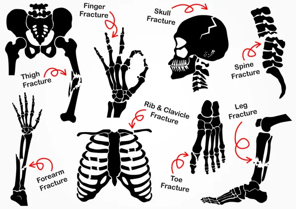 Set Bone Fracture Icon ( Pelvic , Hip , Thigh ( femur ) , Hand , Wrist , Finger , Skull , Face , Vertebra , Arm , Elbow , Thorax , Foot , Heel , Leg ) black & white design ( health care concept ) Vector Graphics