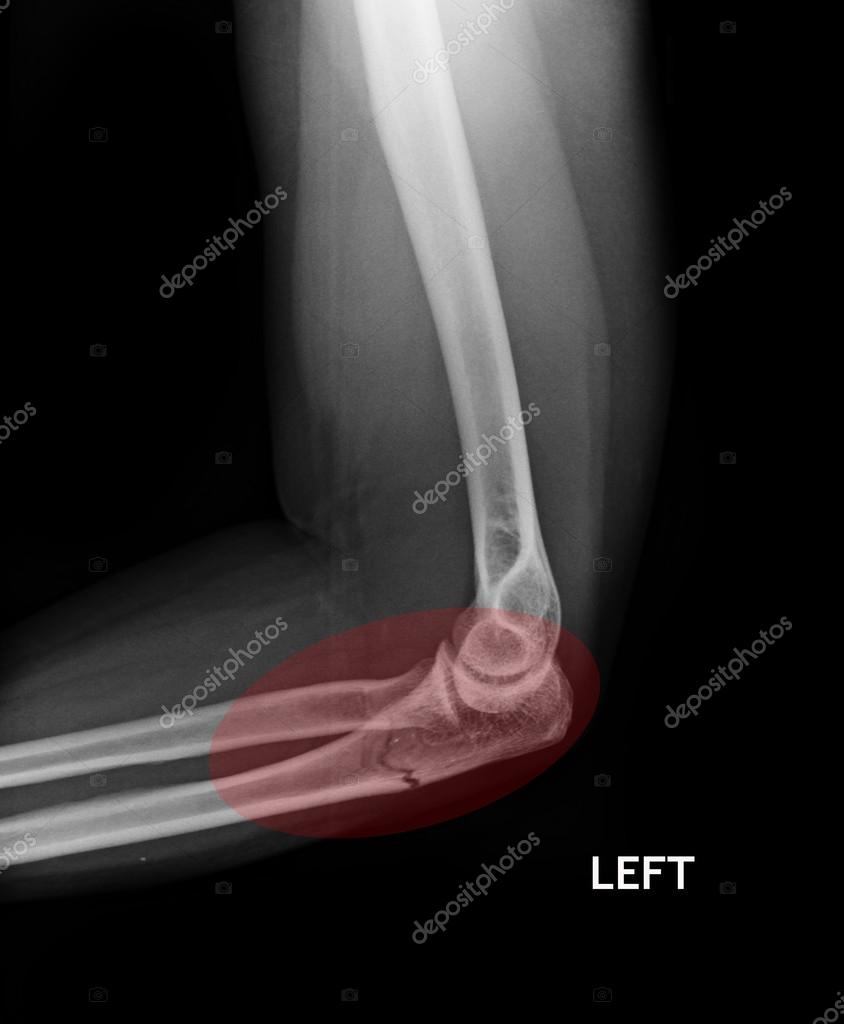 Перелом локтя. Локтевой сустав рентген перелом локтевого. Перелом локтевого отростка со смещением рентген. Трещина локтевой кости рентген. Перелом локтевого сустава рентген.