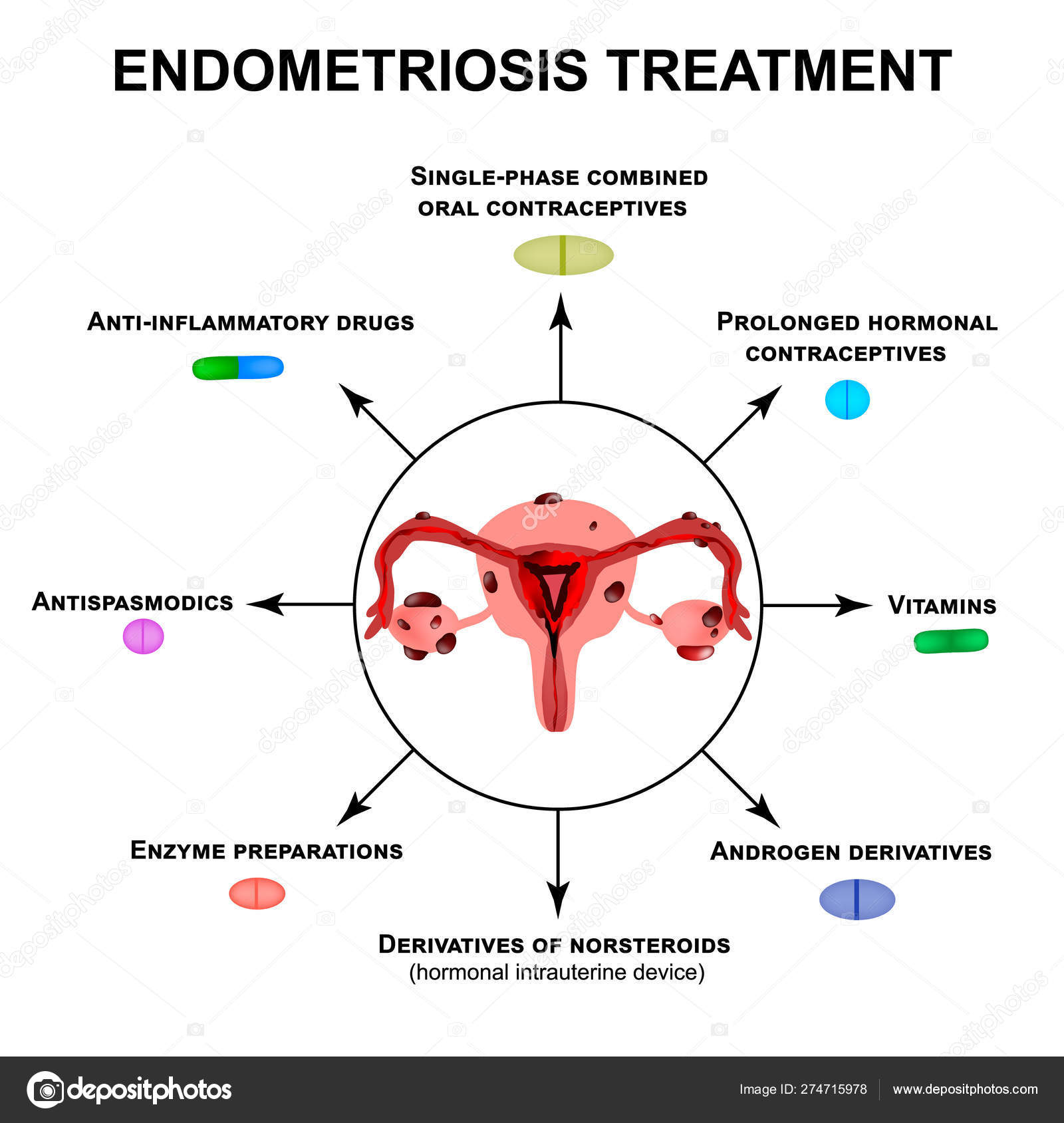 Психосоматика эндометриоза матки. Профилактика эндометриоза. Структура эндометриоза.
