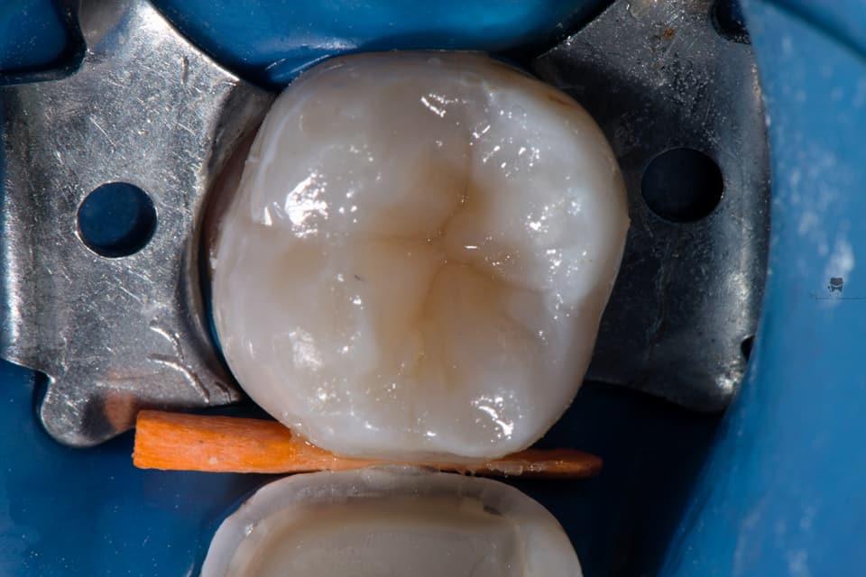 Прямая и непрямая композитные реставрации в практике врача-стоматолога терапевта