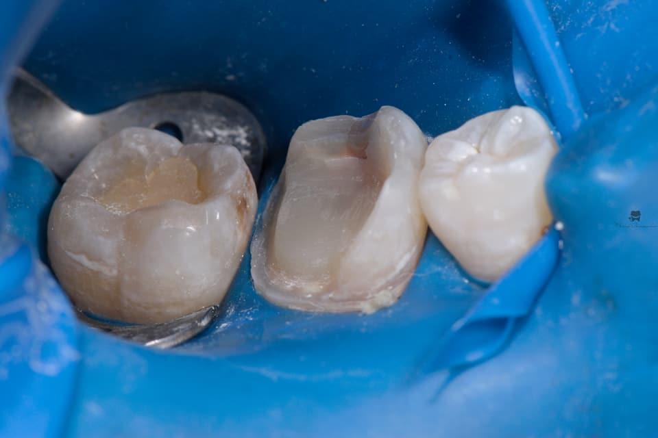 Прямая и непрямая композитные реставрации в практике врача-стоматолога терапевта