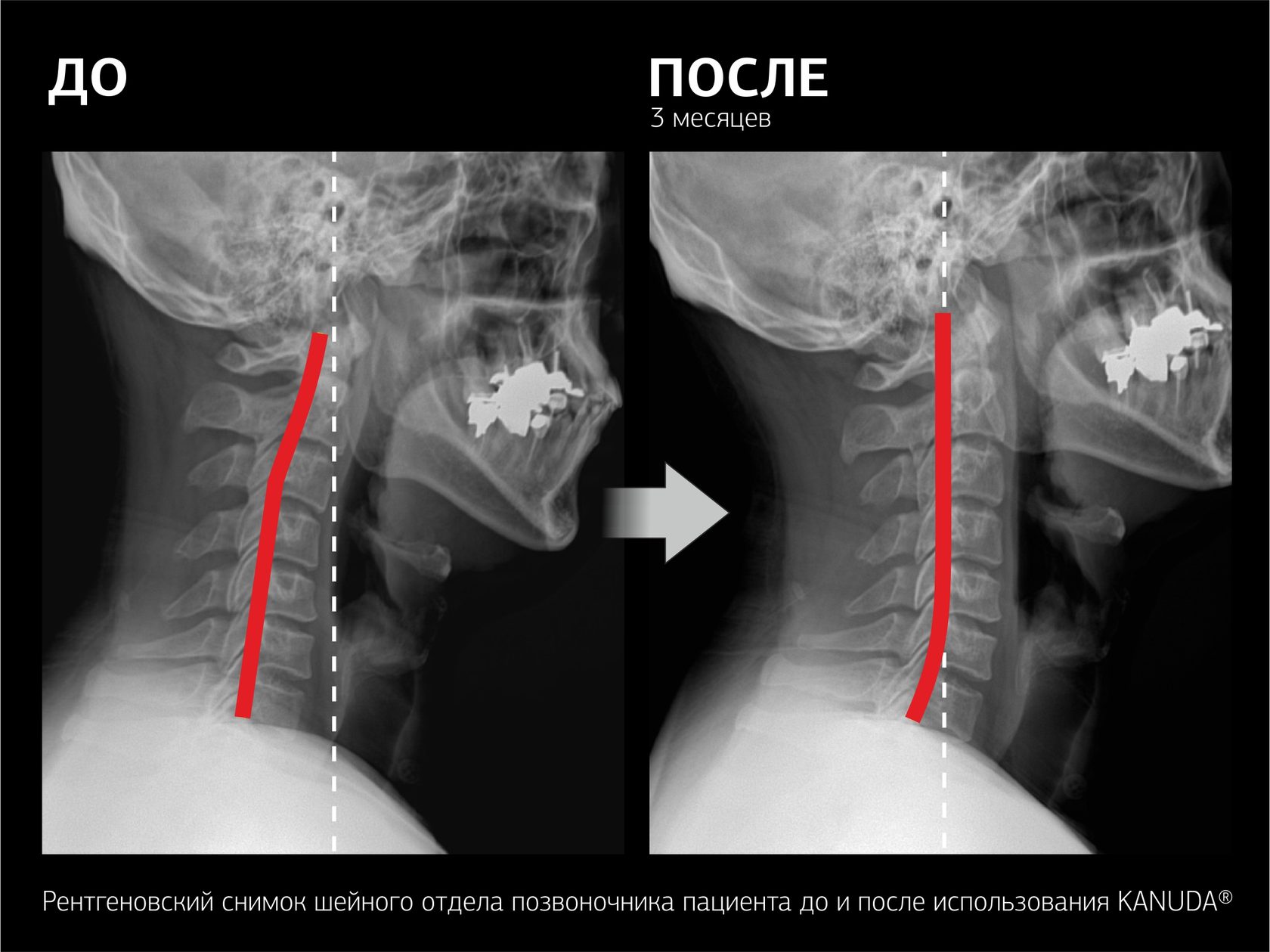 Снимки положений. Правильное положение шейных позвонков. Нормальный шейный отдел. Шейный отдел позвоночника рентген норма. Нормальное расположение шейных позвонков.