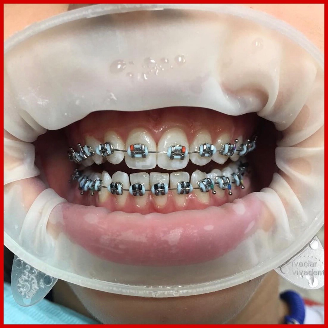 Как выглядят керамические брекеты на зубах фото