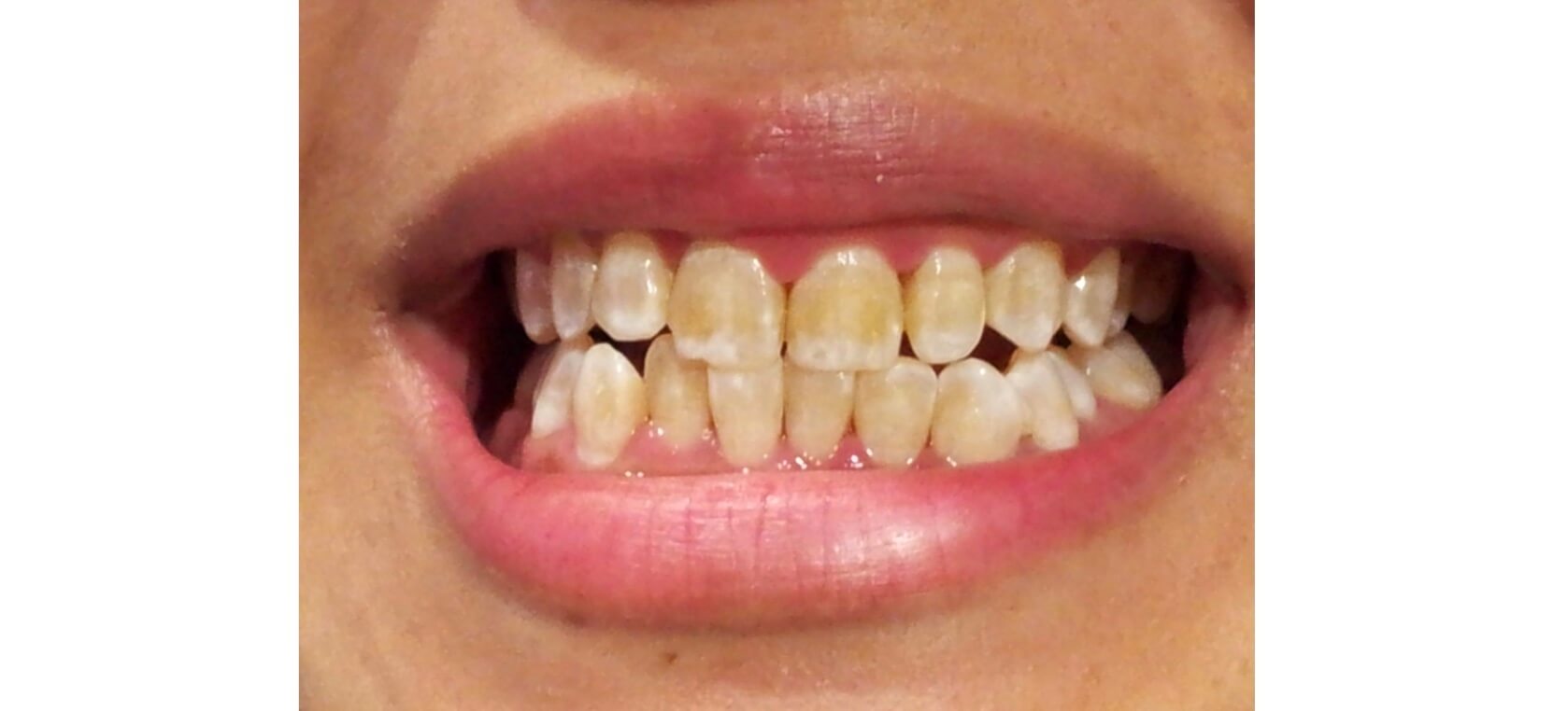 гипоплазия зубов фото