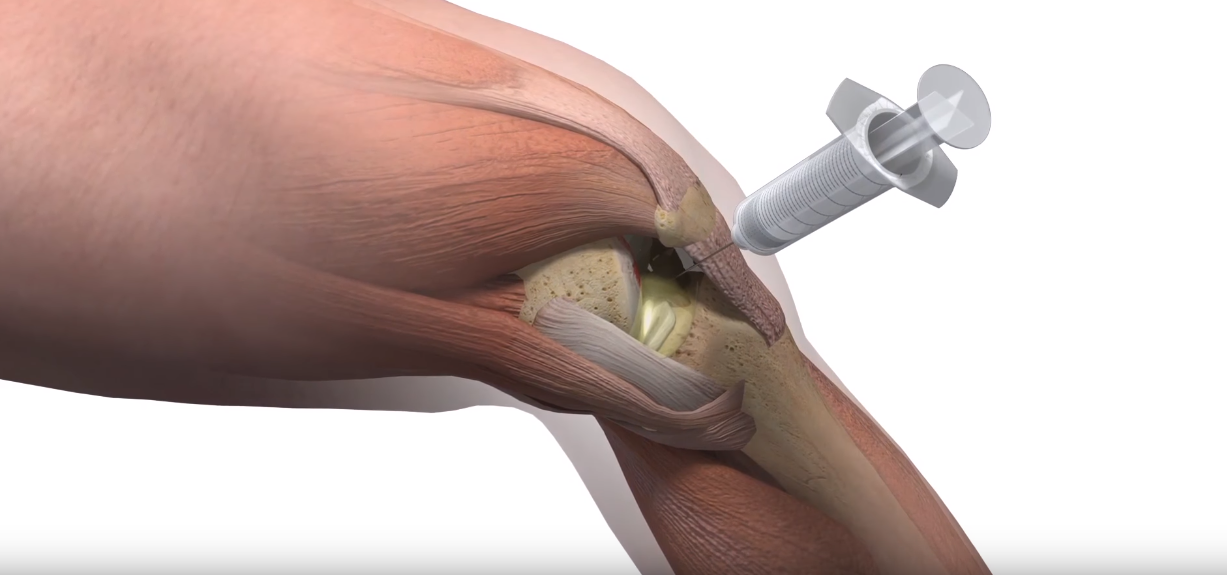 Можно в коленный сустав делать уколы. Внутрисуставные инъекции ГКС. Ферматрон в коленный сустав. Внутрисуставные инъекции в коленный сустав.