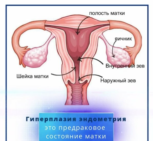 Дисплазия матки что это. Гиперплазия шейки матки. Эндометрия шейки матки.