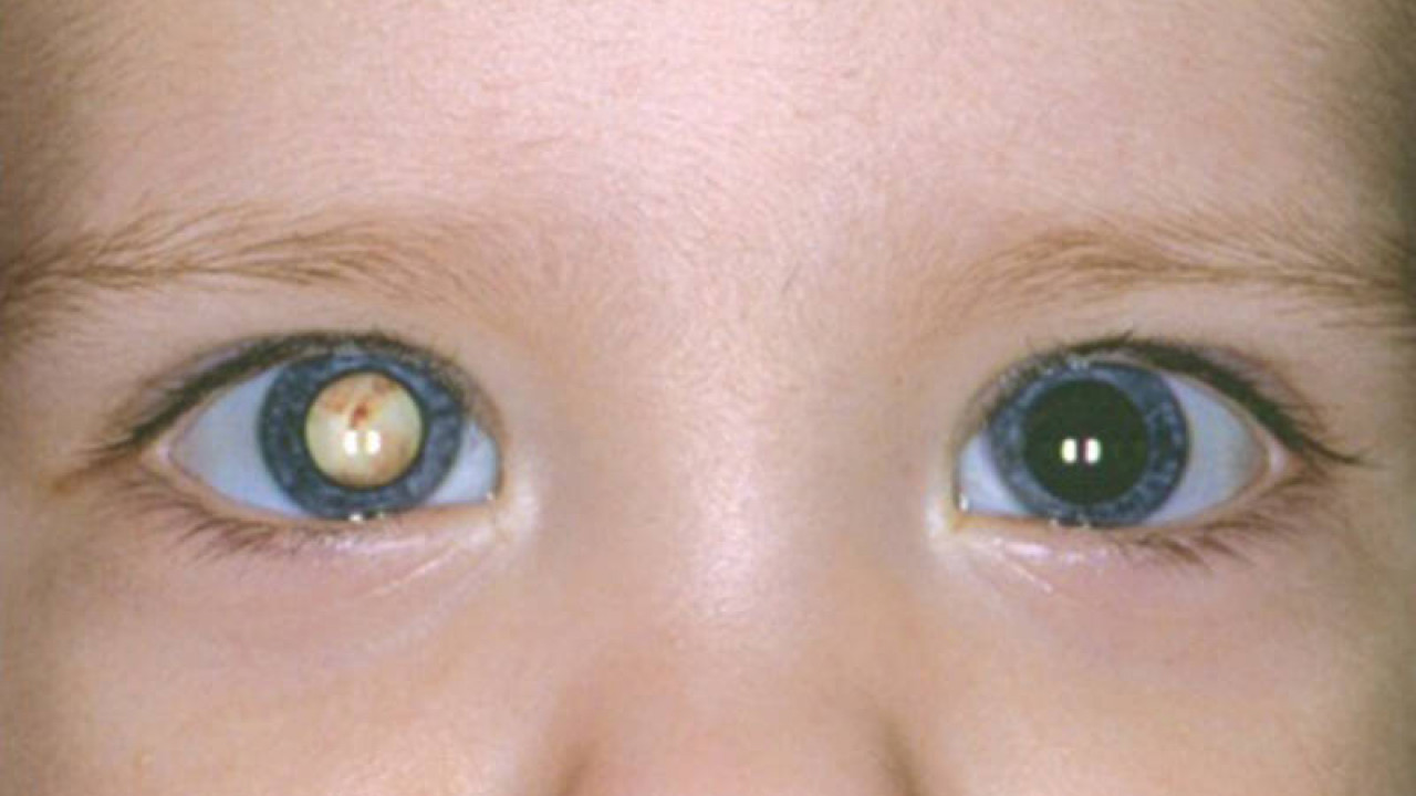 Глазки форум. Врожденная катаракта ретинобластома. Катаракта амблиопия врожденная. Врожденная глаукома буфтальм. Синдром ретинобластома.