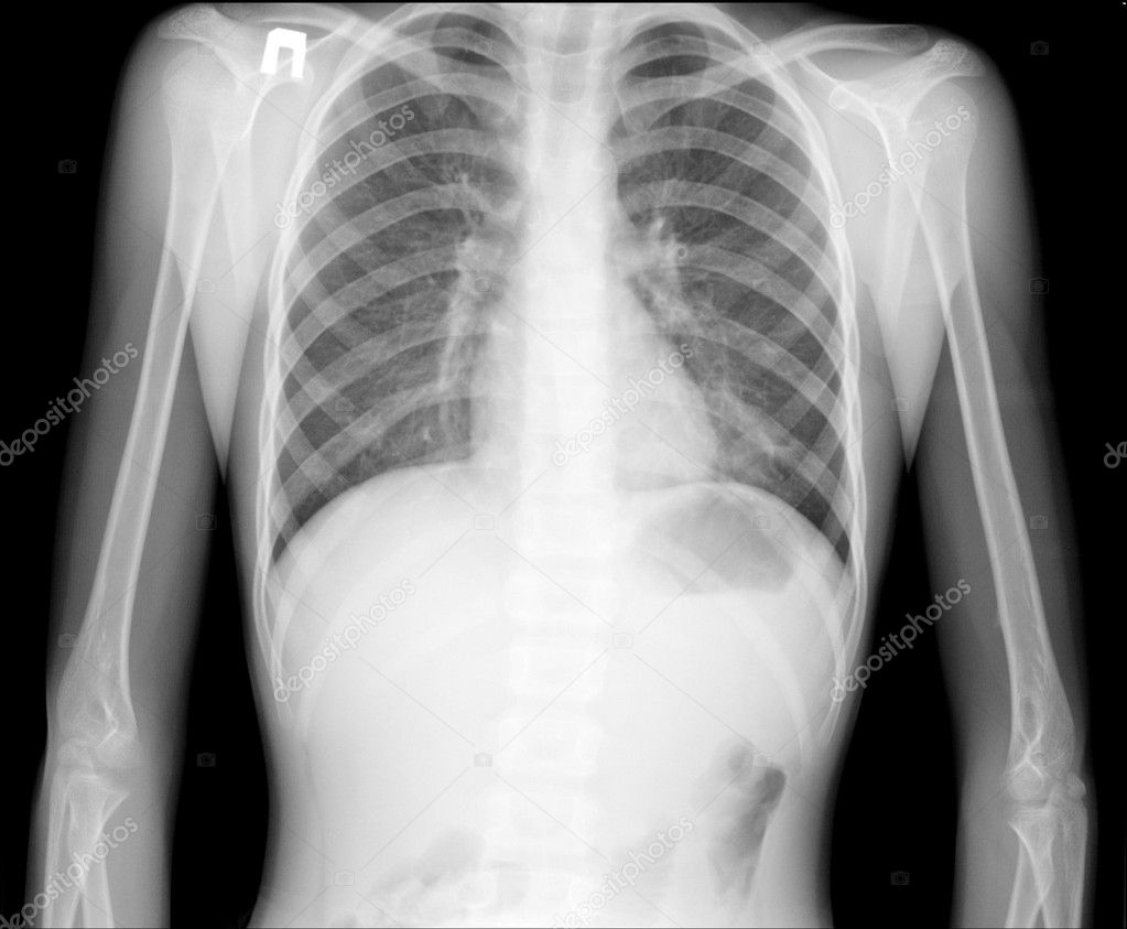 Рентген грудной клетки рядом со мной