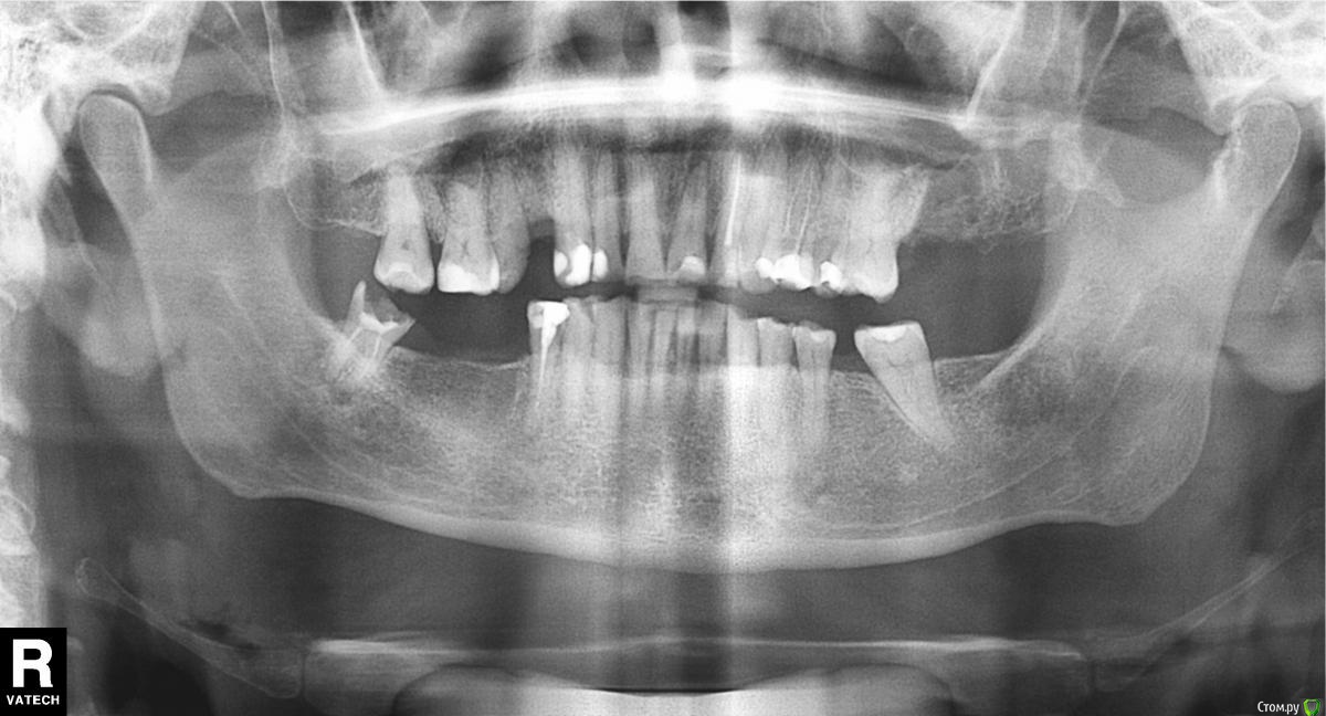 Оптг снимок. Ортопантомограмма адентия. Ортопантомограмма (ОПГ).