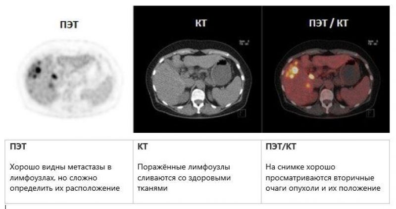 Пэт кт или кт что лучше. ПЭТ/кт с туморотропными РФП (18f-фтордезоксиглюкоза). ПЭТ кт исследование онкология.