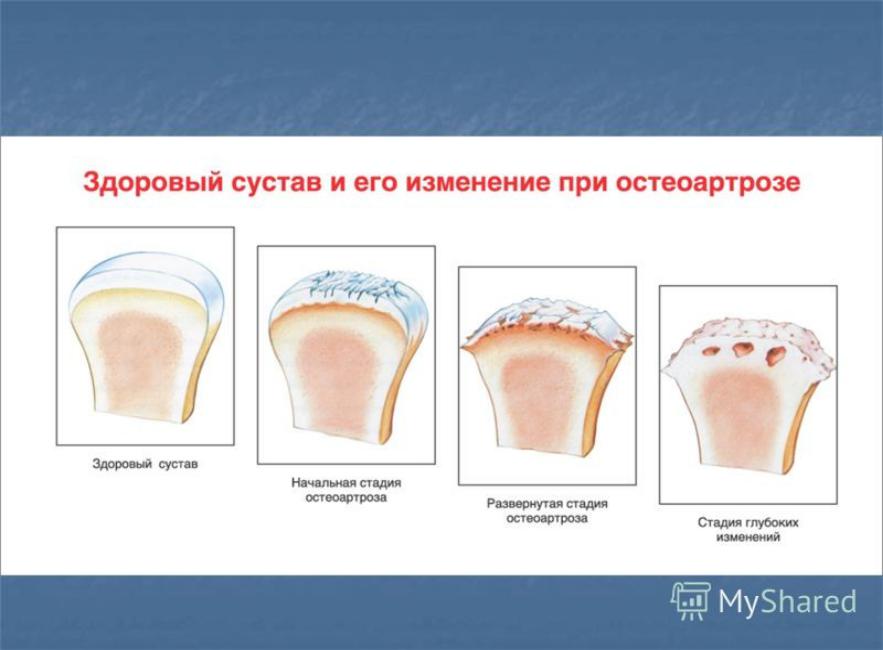 Деформирующий остеоартроз клиническая картина