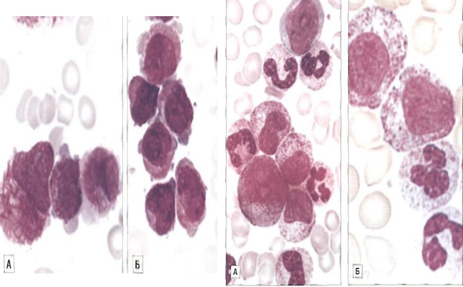 Миелоидный лейкоз. Острый миелоидный лейкоз картина крови. Хронический миелолейкоз и острый лейкоз. Миелобластный лейкоз гистология. Хронический миелолейкоз микроскопия.