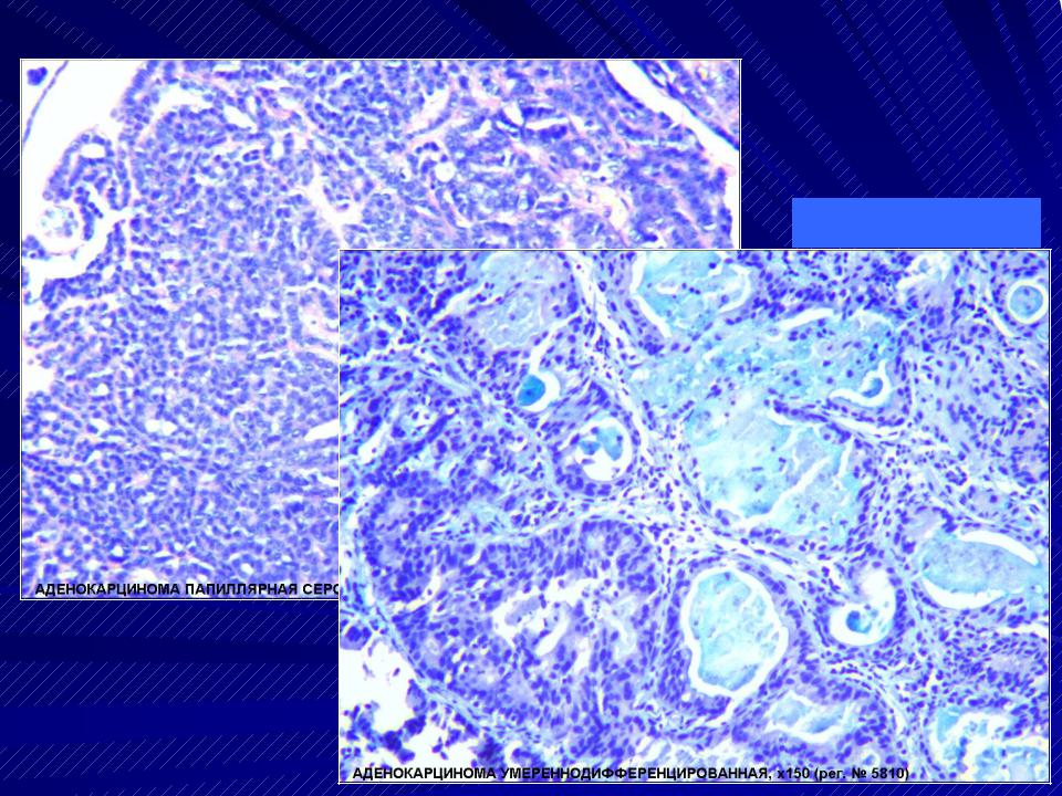 Аденокарцинома железы. Ацинарная аденокарцинома гистология. Ацинарная аденокарцинома предстательной железы гистология. Папиллярная аденокарцинома гистология. Слизеобразующая аденокарцинома легкого гистология.