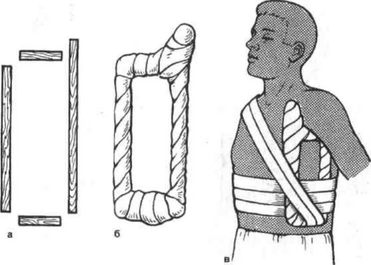 Гипсовые повязки шины. Перелом ключицы рамка Чижина. Рамка Чижина при переломе ключицы. Гипсовая иммобилизация при переломе ключицы. Иммобилизация при переломе ключицы повязка.