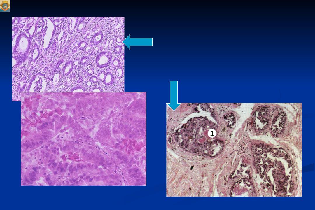 Аденокарцинома что это. Протоковая карцинома молочной железы микропрепарат. Скиррозная аденокарцинома. Карцинома и аденокарцинома. Аденокарцинома молочной железы микропрепарат.