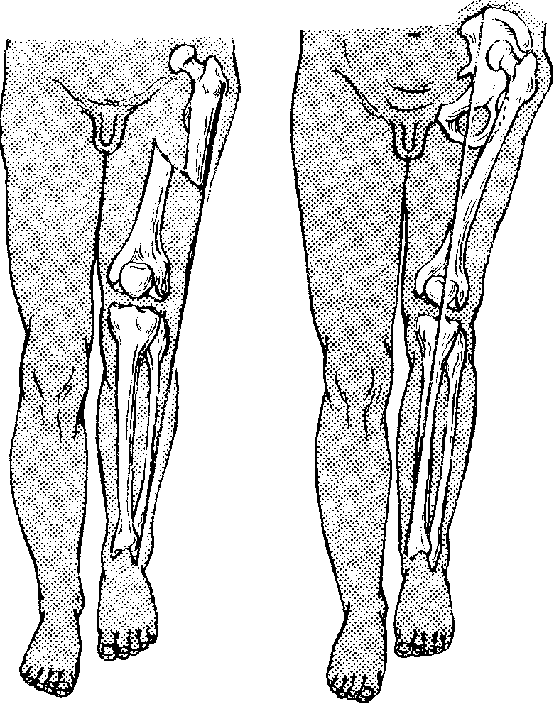 Контрактура коленного сустава фото