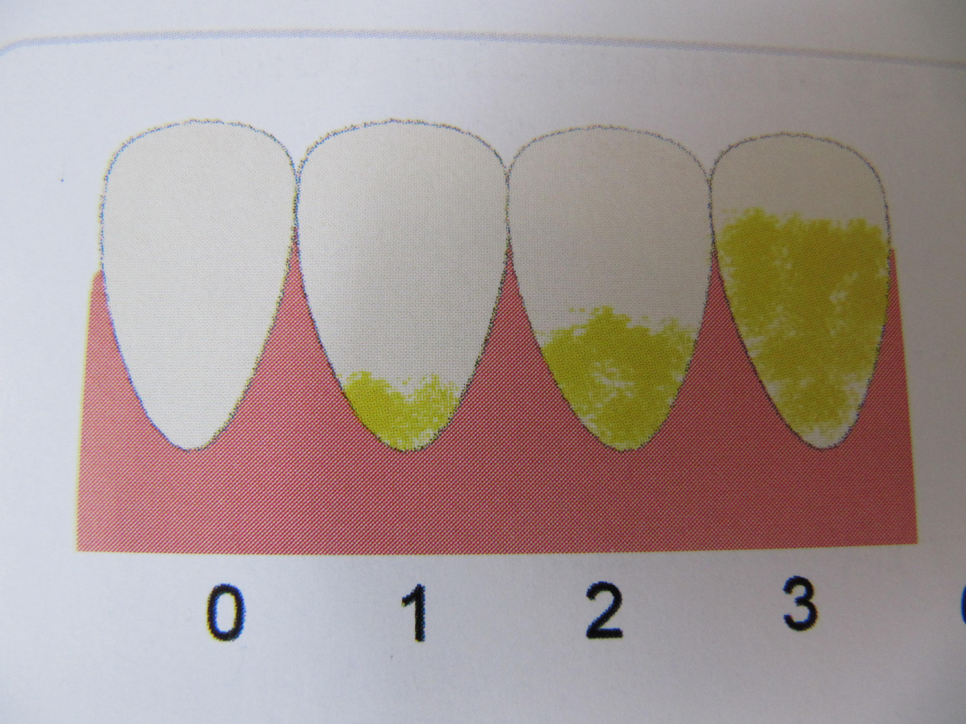 Индекс десна. Зубной налет у молочных зубов. Пожелтение эмали молочных зубов. Налет на эмали молочных зубов.