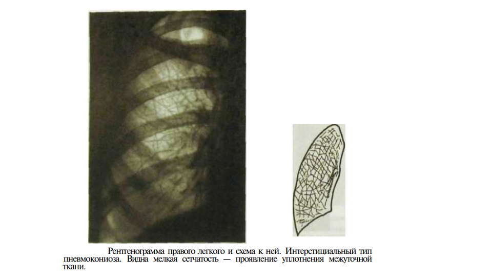 Фиброзно изменен легочный рисунок что это значит