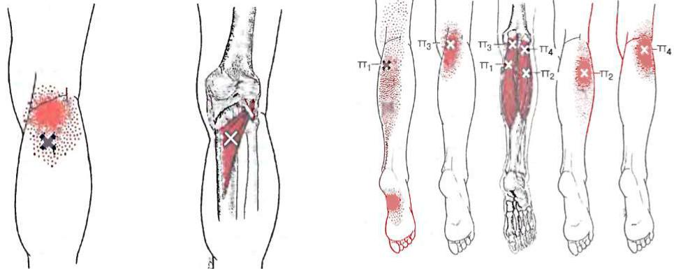 Триггерные точки на ногах человека фото