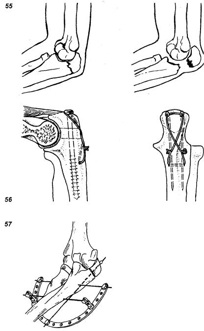 Перелом локтевого отростка. Остеосинтез перелома локтевого отростка по Веберу. Остеосинтез локтевого отростка по Веберу рентген. Остеосинтез перелома локтевого отростка по Веберу схема. Перелом локтевого отростка остеосинтез.