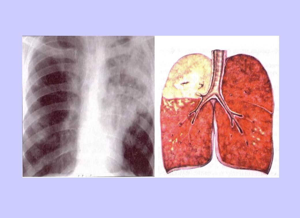 Легкое течение пневмонии. Казеозная пневмония макропрепарат. Казеозная пневмония туберкулез рентген. Казеозная и крупозная пневмония. Казеозная пневмония легких рентген.