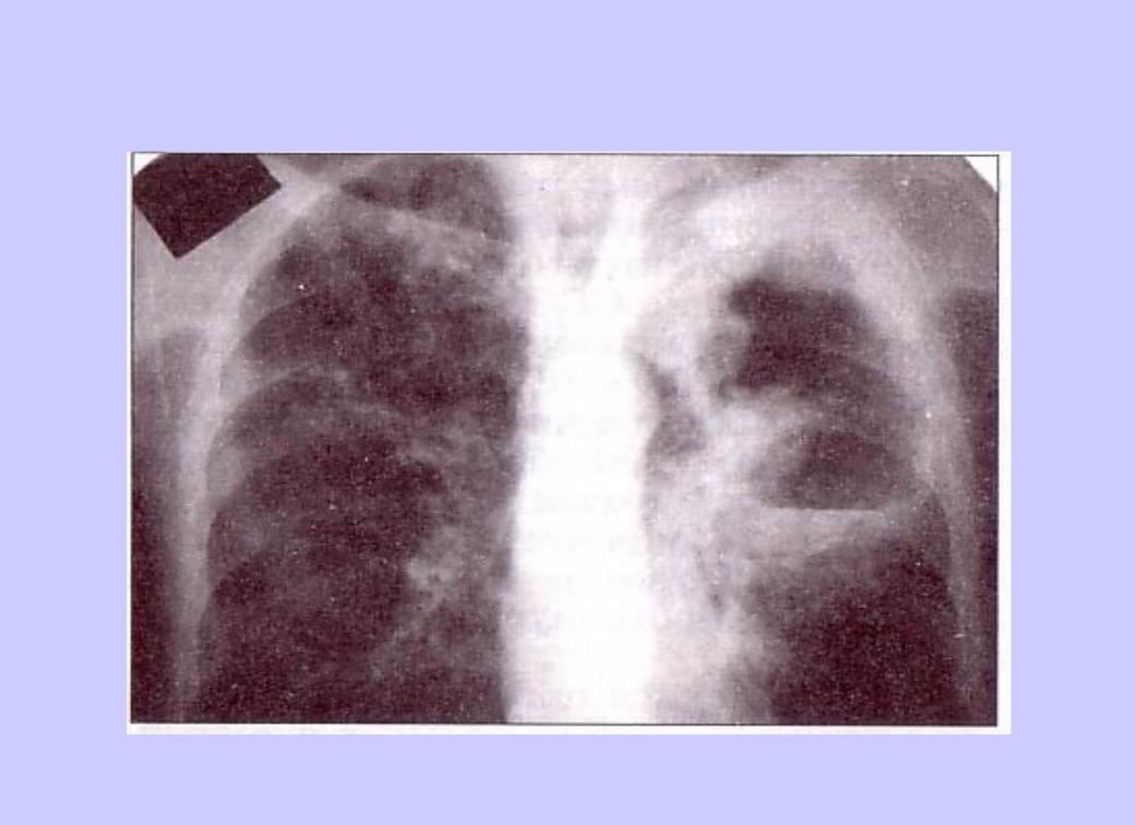 Туберкулез легкого рентгенограмма. Каверна туберкулез рентген. Туберкулезная каверна рентген. Фиброзно-кавернозный туберкулез. Фиброзно-кавернозный туберкулез рентген.