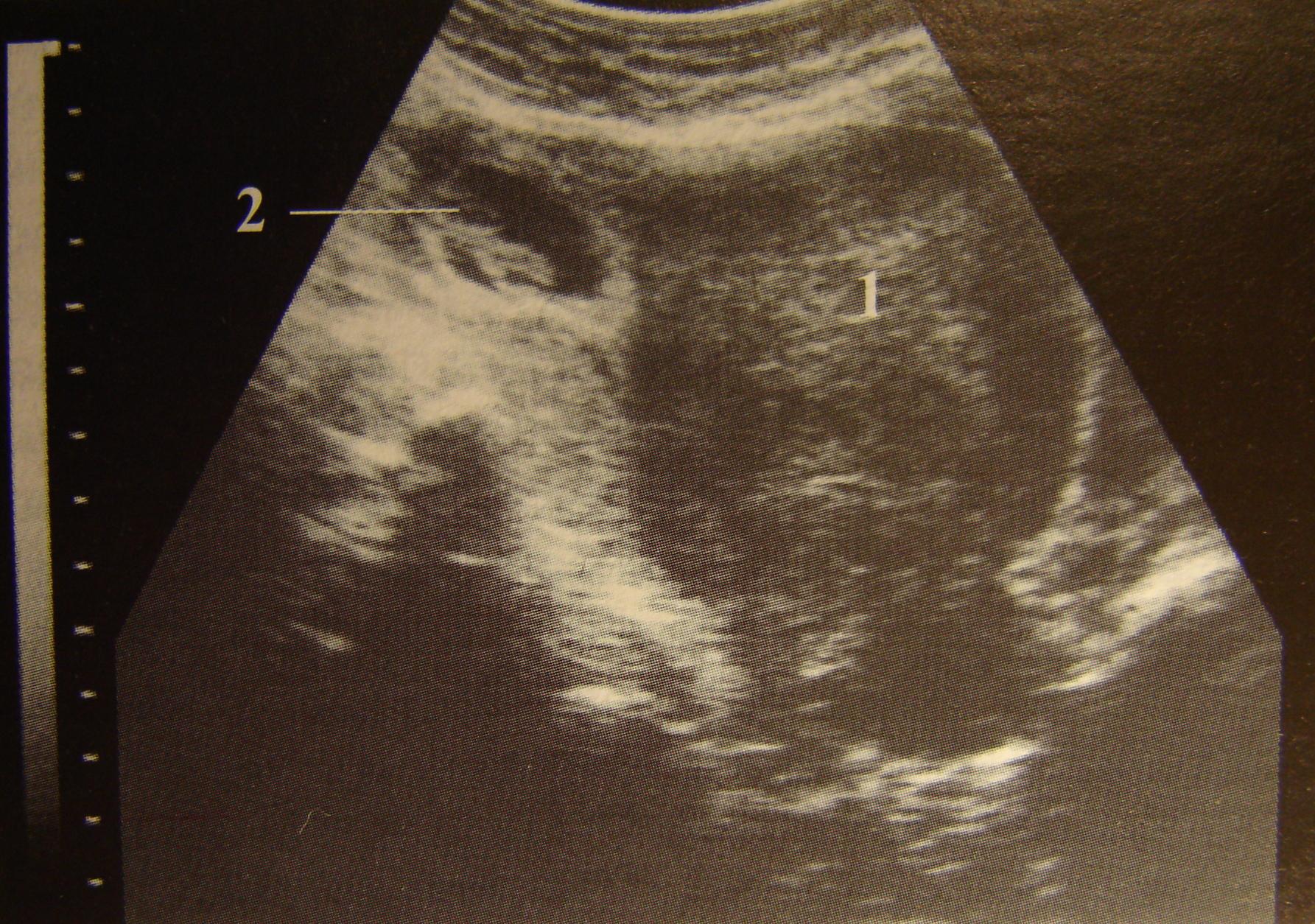 грудь при внематочной беременности фото 73