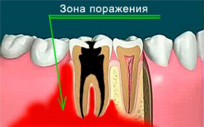 Надкостница зуба картинка