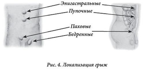 Грыжа Живота Симптомы Фото