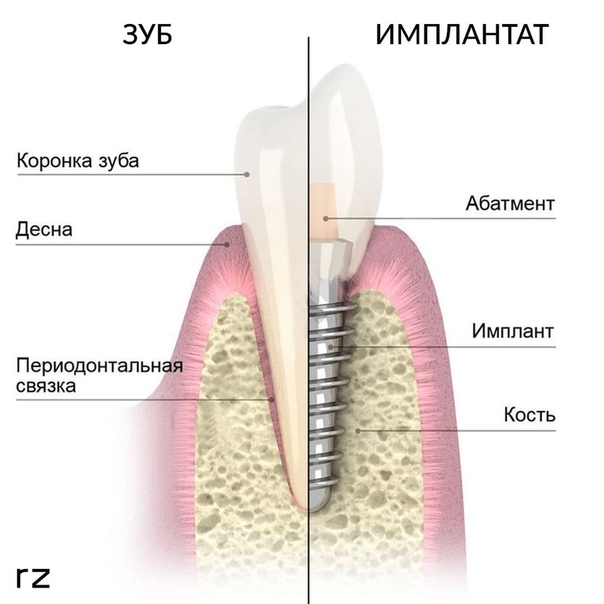 Схема установки импланта зуба