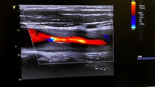 Закупорка сонной артерии фото