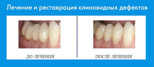 Белая опустилась. Коронковый клиновидный дефект. Клиновидный дефект и эрозия эмали. Разрушение зубов клиновидный дефект.