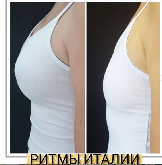 Безоперационная подтяжка грудных желез фото до и после