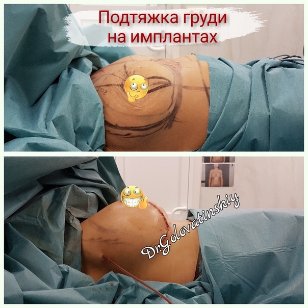 Как выглядит грудь после маммопластики Мастопексия сколько стоит: Подтяжка груди (мастопексия) в СПБ: фото и цены - Сто