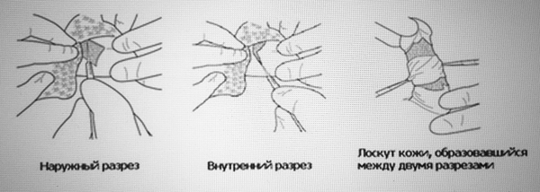 Обрезание у детей схема плюсы и минусы - 92 фото