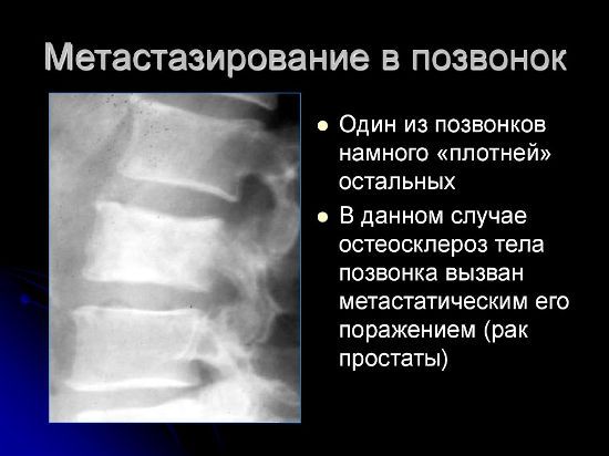 Метастазирование в позвонок