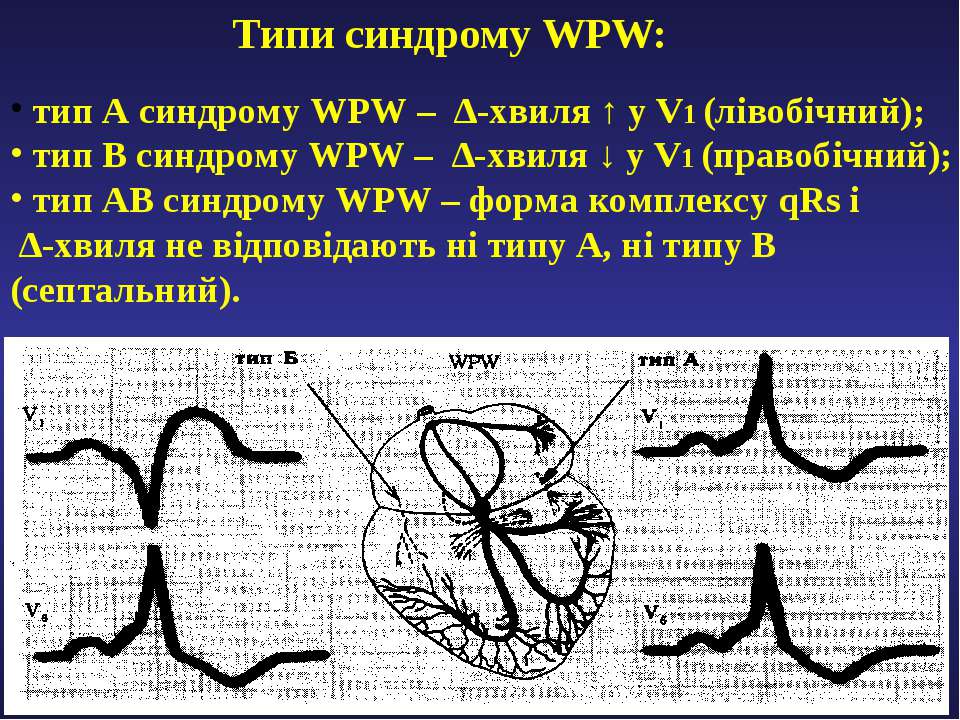 Синдром типа б. Типы синдрома wpw. Wpw синдром Тип b на ЭКГ. Тип а при синдроме wpw. Типы ВПВ синдрома на ЭКГ.