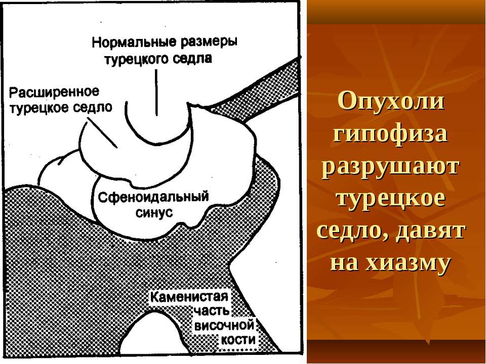 Турецкое седло. Опухоль в области турецкого седла. Турецкое седло гипофиза опухоль. Стенки турецкого седла. Полость турецкого седла.