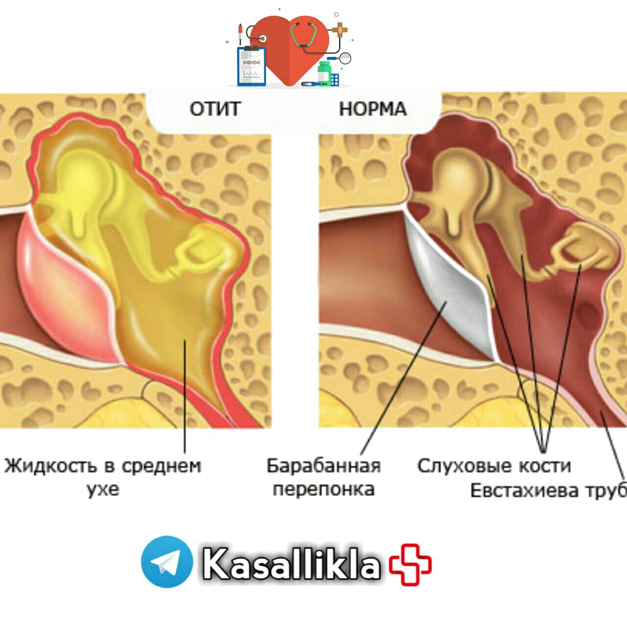 Причины воспаления среднего уха. Правосторонний острый Гнойный средний отит. Баротравматический отит. Средний катаральный отит уха.