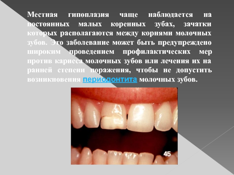 Эмал вый меньш нство. Системная гипоплазия эмали эрозивная форма. Системная гипоплазия эмали зубов. Местная гипоплазия эмали молочных зубов..