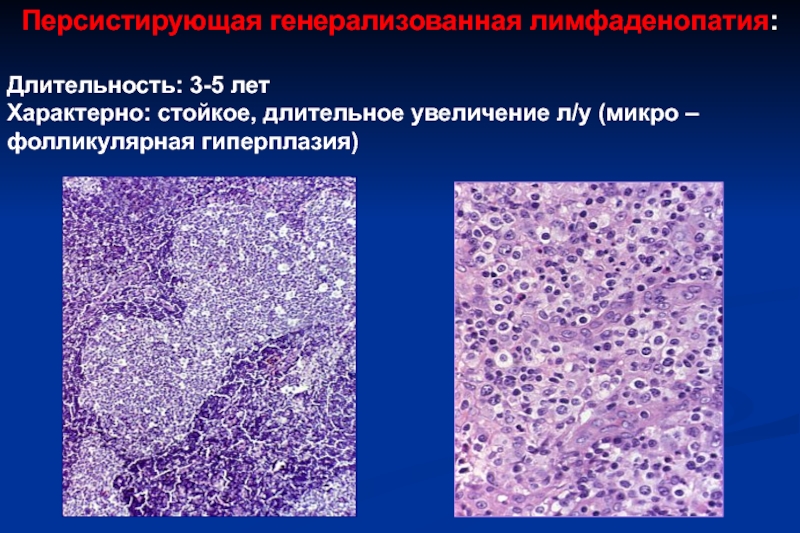 Увеличение л. Фолликулярная гиперплазия. Гиперплазия викулярная. Гиперплазия резервных клеток. Воспаление и иммунопатологические состояния.