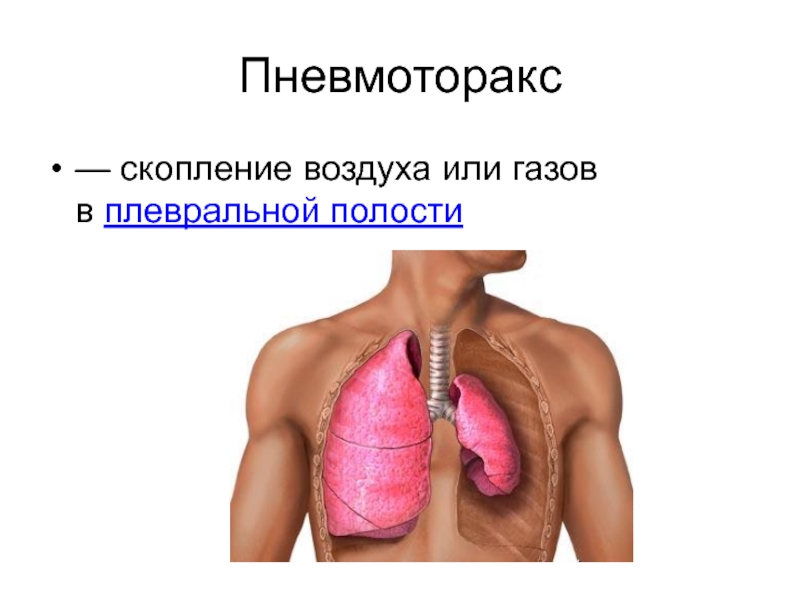 Спонтанный пневмоторакс. Идиопатический пневмоторакс. Пневмоторакс физиология. Рецидивный пневмоторакс. Двухсторонний пневмоторакс.