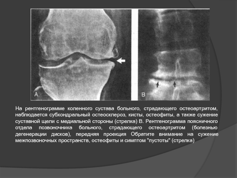 Склероз суставных поверхностей. Остеосклероз позвоночника рентген. Субхондральный остеосклероз мрт. Остеосклероз позвонка рентген.