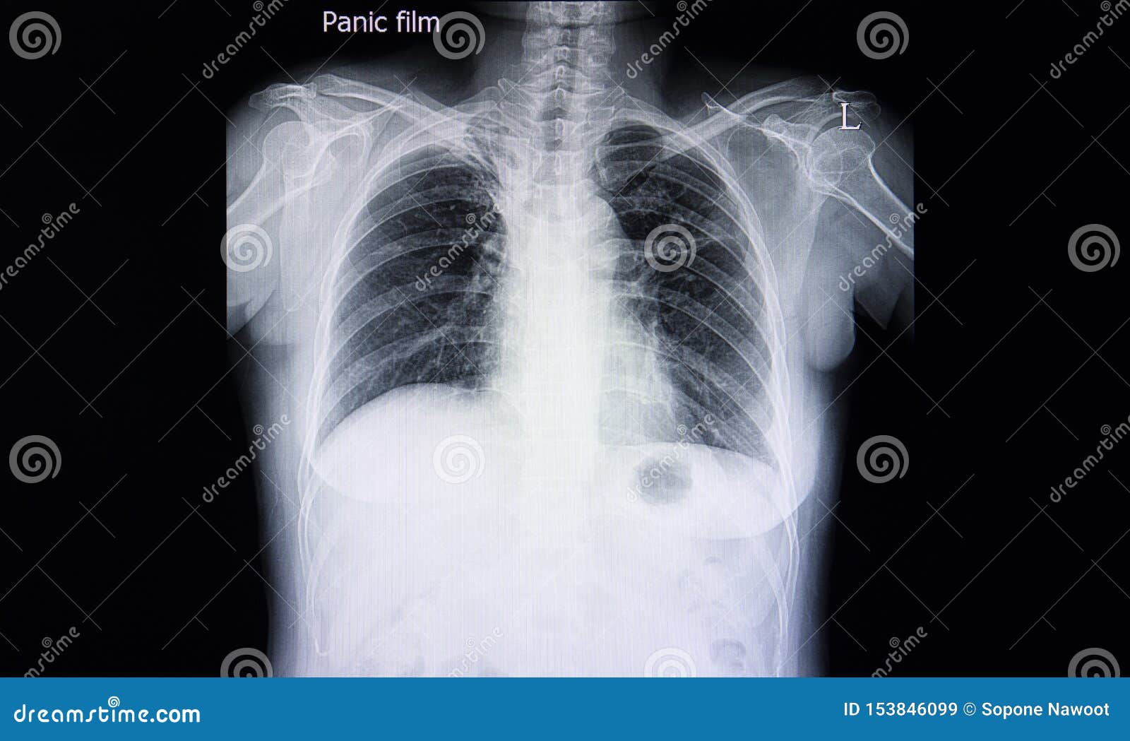 Жесткая рентгенограмма легких