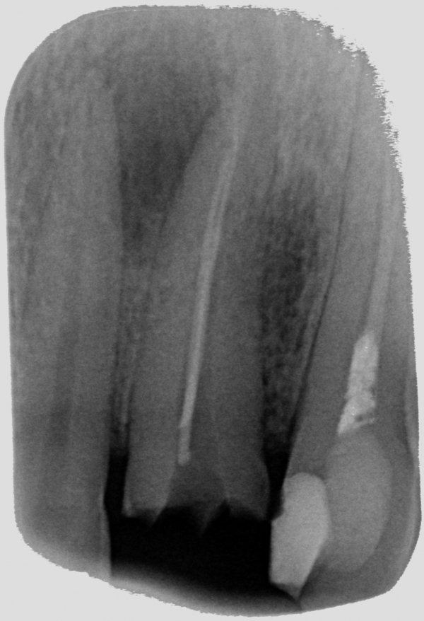 Рассосался корень зуба. Киста переднего верхнего зуба рентген. Киста на корне верхнего зуба.