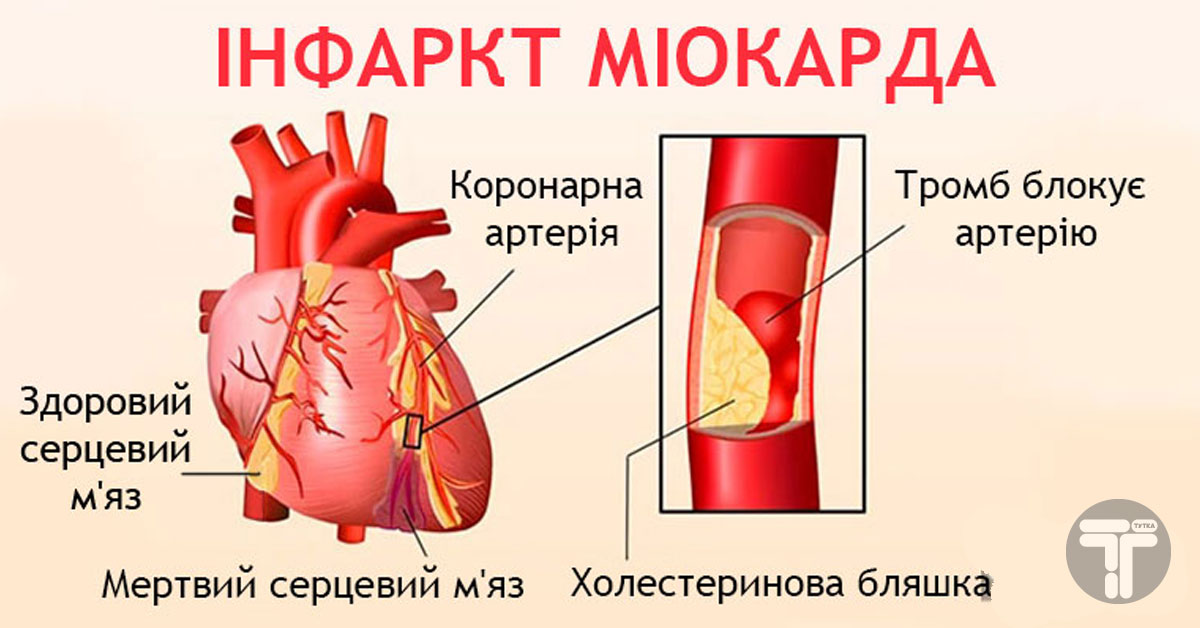 Тромб в правом. Строение сердца при инфаркте миокарда. Симптомы ИБС инфаркт миокарда. Коронарные артерии при инфаркте миокарда. Закупорка тромбов в коронарной артерии.