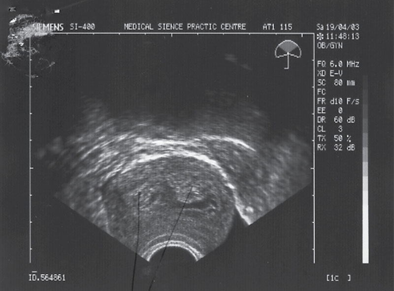 Эндометрий 4 3. Расширение полости матки при беременности на ранних сроках. Эндометрий на ранних сроках беременности УЗИ. УЗИ беременность эндометрий 9 мм. Эндометрий 16 мм при беременности на ранних сроках.